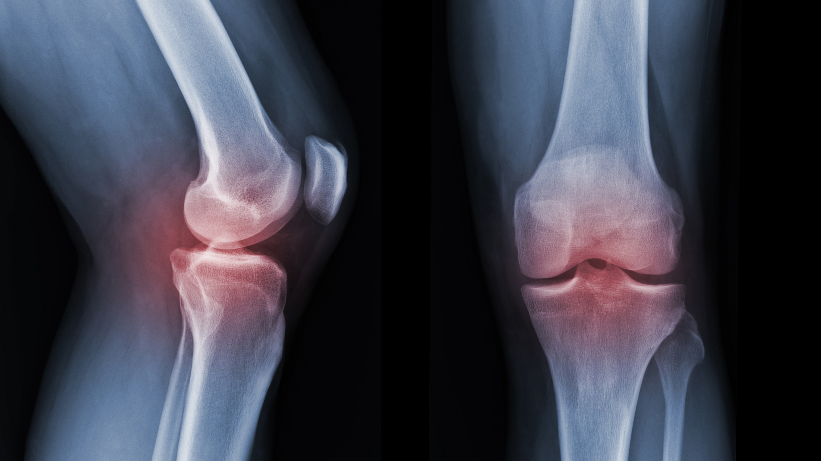 Osteoarthritis Lutut: Gejala Awal yang Sering Tidak Disadari (Foto: Canva)